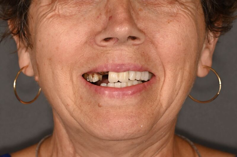 boteanu ilinca - inainte